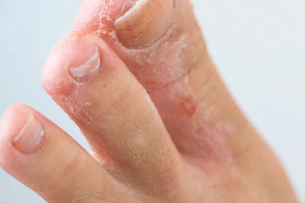 Athlete’s Foot Symptoms: Itchy, Peeling Skin Between the Toes