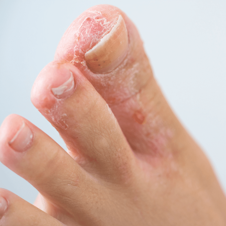 Athlete’s Foot Symptoms: Itchy, Peeling Skin Between the Toes