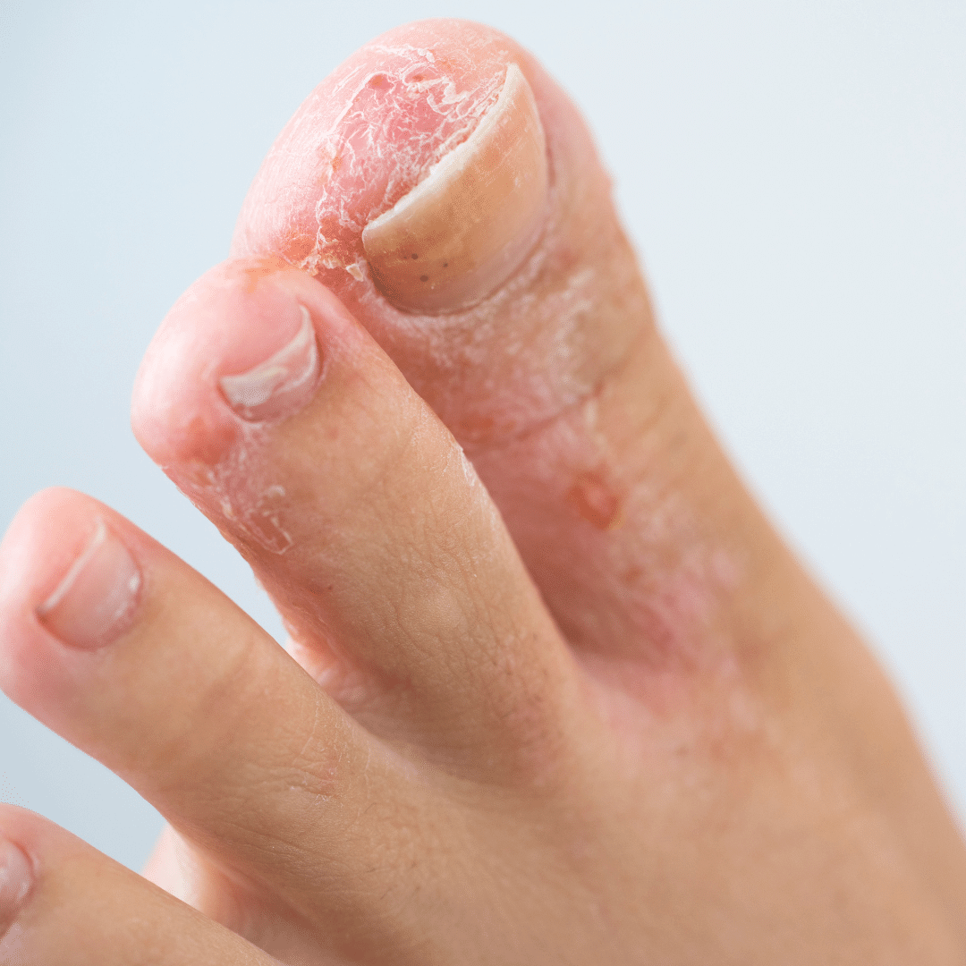 Athlete’s Foot Symptoms: Itchy, Peeling Skin Between the Toes