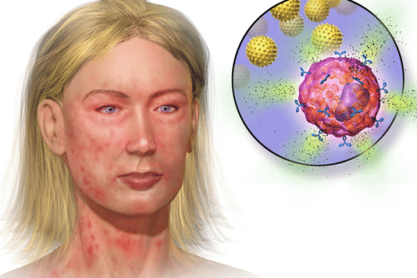 Anaphylaxis Symptoms – Life Threatening Signs Needing Immediate Help