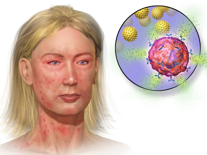 Anaphylaxis Symptoms – Life Threatening Signs Needing Immediate Help