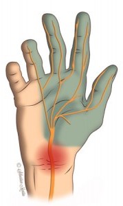 Carpal Tunnel Syndrome Symptoms: Numb, Tingling Hands at Night
