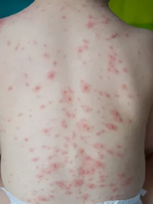 Chickenpox Symptoms: Rash Stages in Children Explained