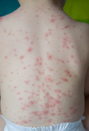 Chickenpox Symptoms: Rash Stages in Children Explained