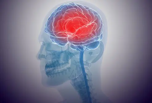Encephalitis Symptoms: Brain Inflammation Signs That Need Urgent Care