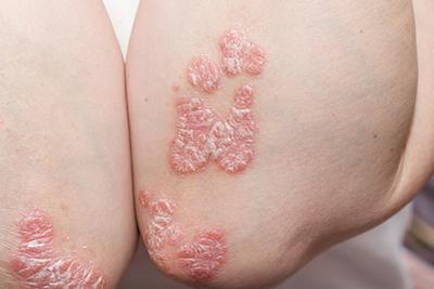 Psoriasis Symptoms: Scaly Skin Patches, Nail Changes, and Common Triggers