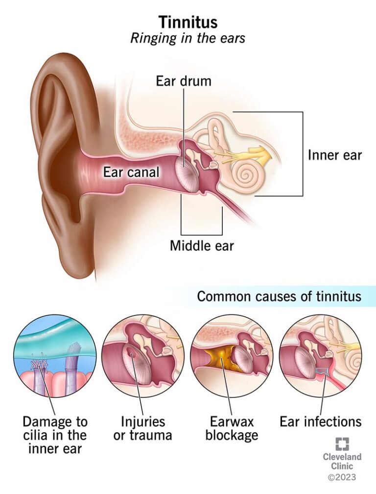 Tinnitus Symptoms: Constant Ringing Inside Your Ears