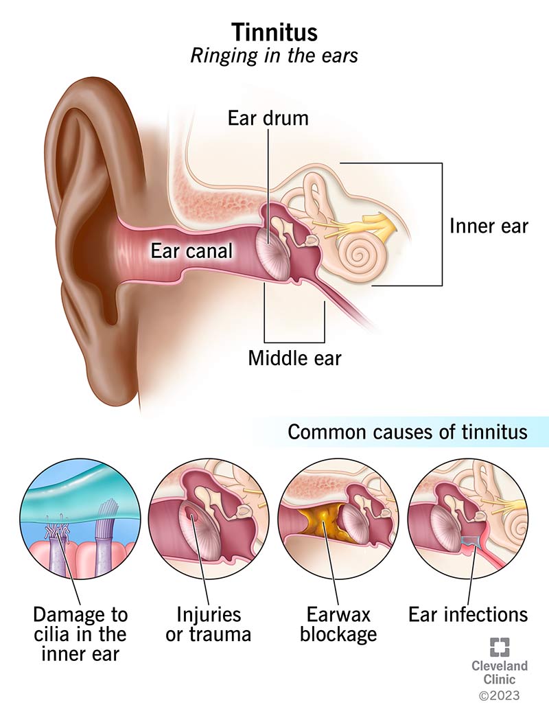 Tinnitus Symptoms: Constant Ringing Inside Your Ears