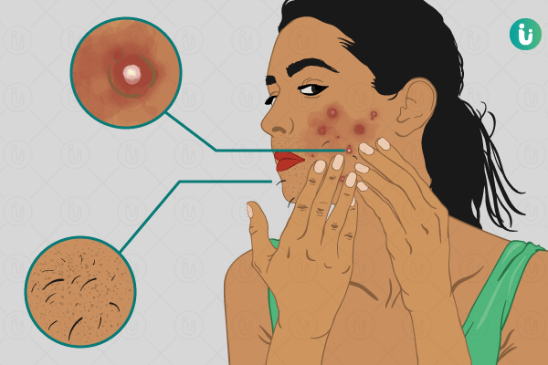 PCOS Symptoms – Hormonal Signs Young Women Face