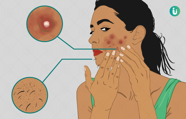 PCOS Symptoms – Hormonal Signs Young Women Face